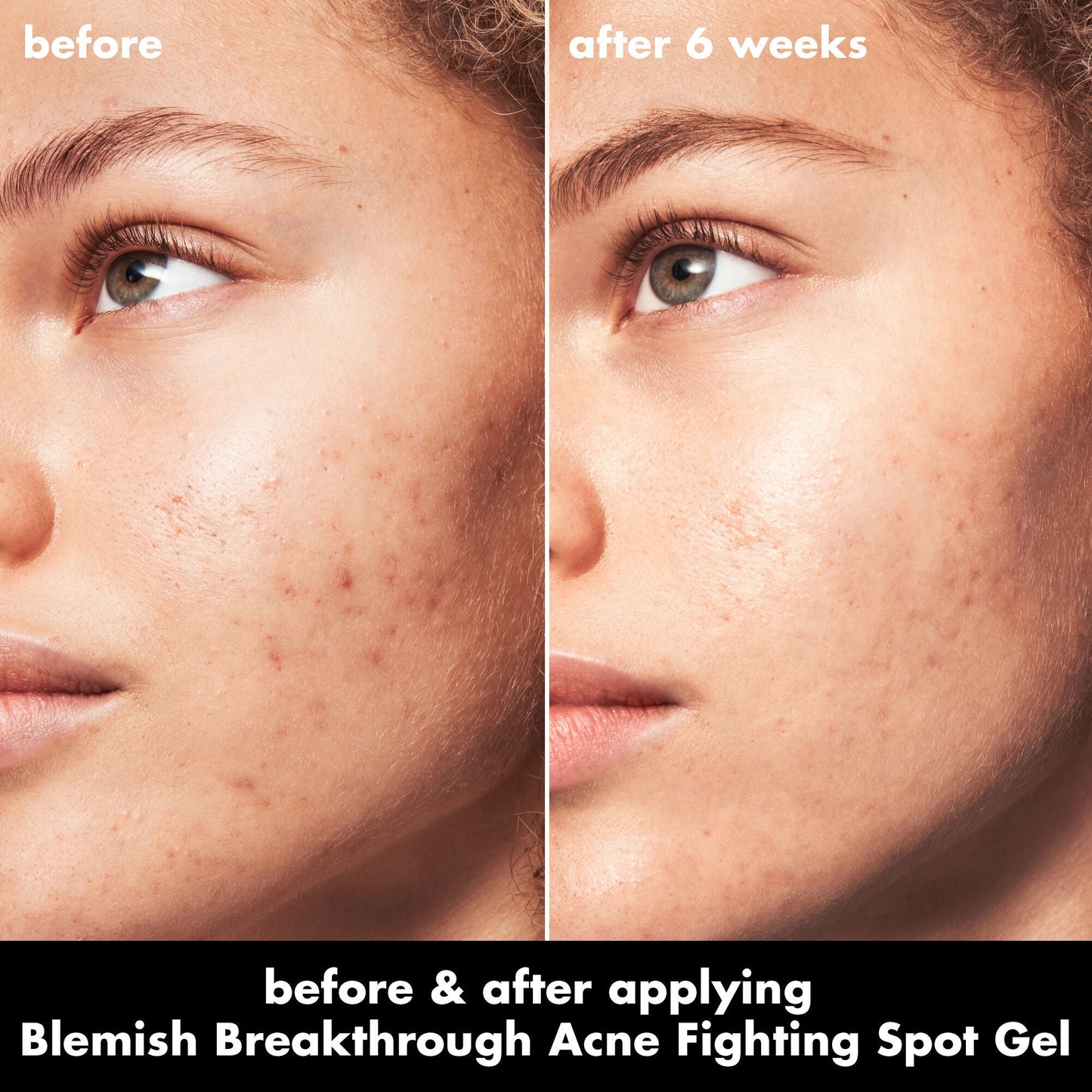 blemish-breakthrough-acne-fighting-spot-gel-x3 0326_EDU_BB_SpotGel_BA_MARLEY.jpg