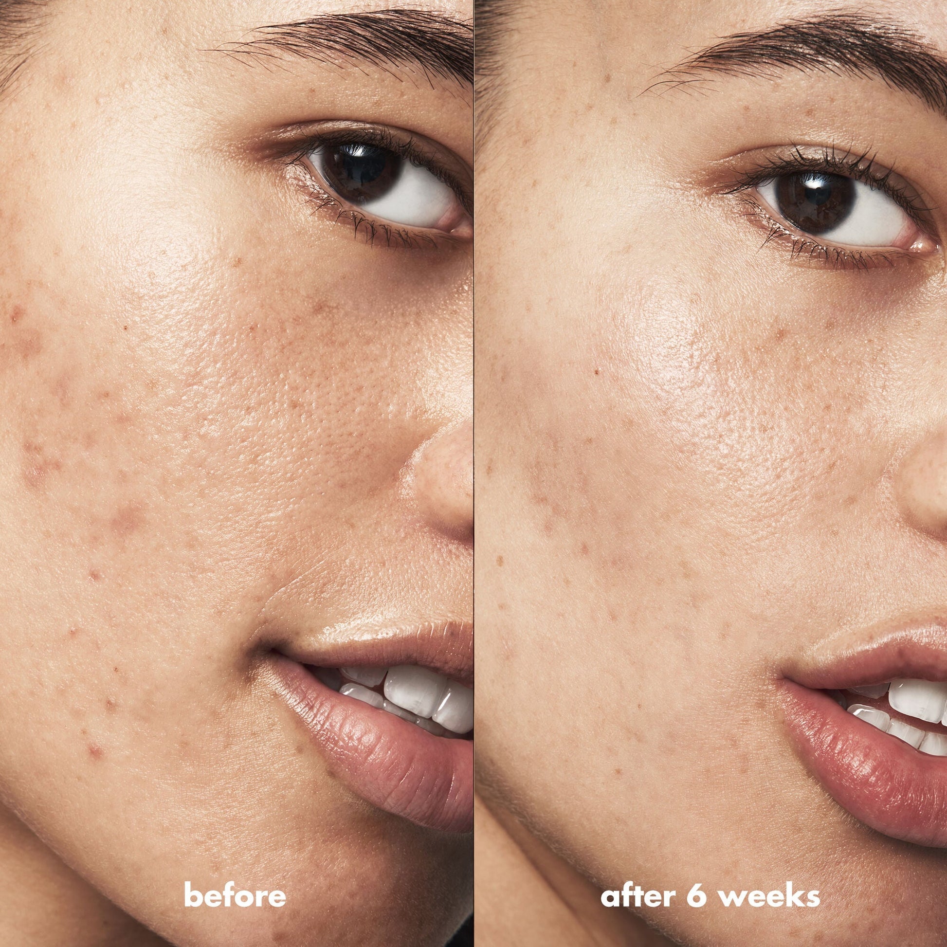 blemish-breakthrough-triple-acid-resurfacing-serum-e1 Acne_PDP_Isabella_Before_After_b8fe0505-ae5c-4baa-9a8e-fd889e4c3414.jpg