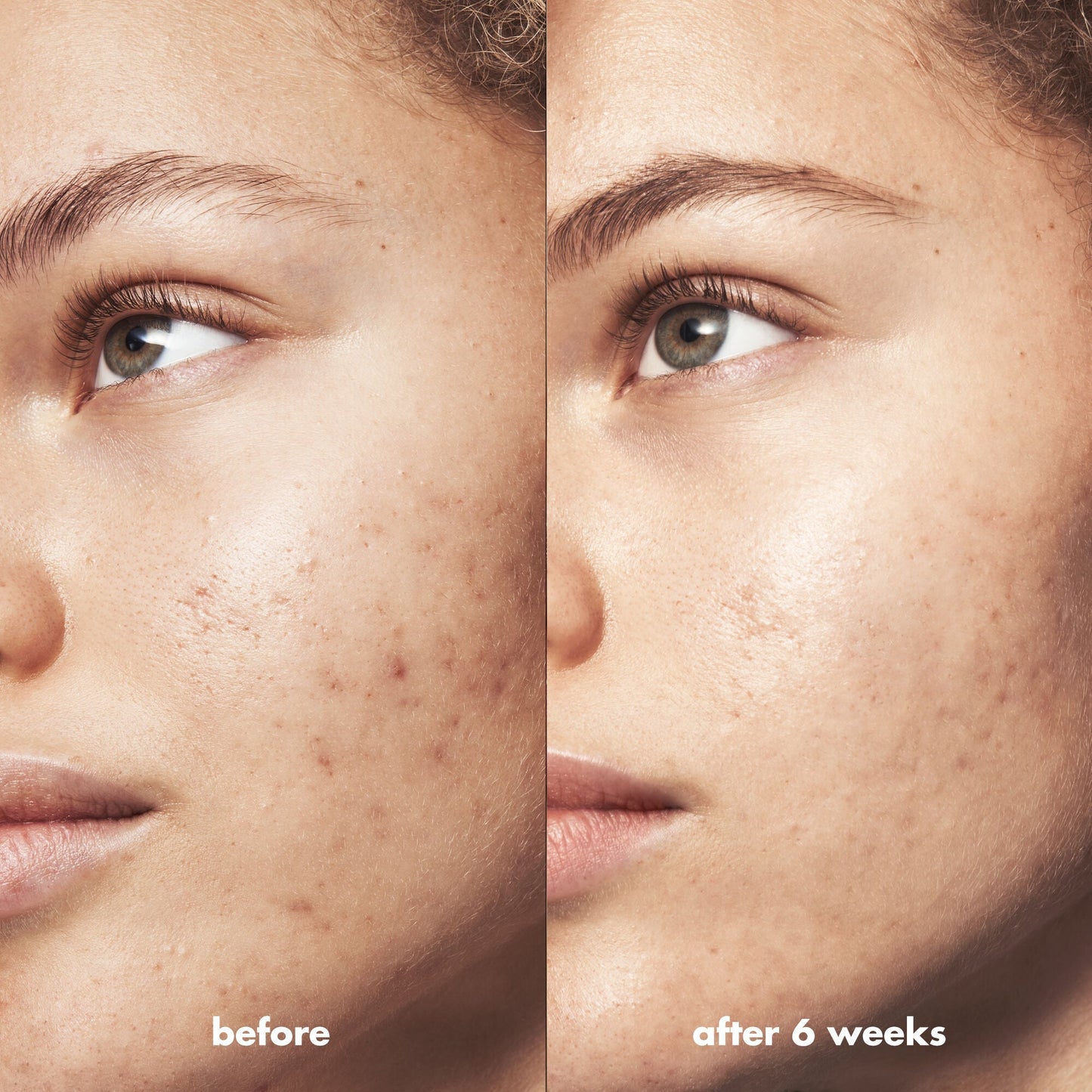 blemish-breakthrough-acne-calming-water-cream-mini-p1 Acne_PDP_Marley_Before_After_acf01478-a58b-47ce-99b5-2ef1dc022f9b.jpg